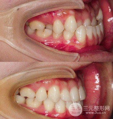 整牙齿多少钱