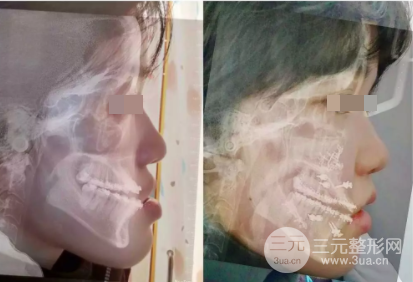 整牙齿多少钱