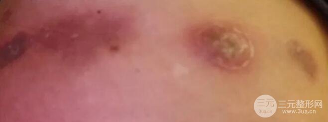 惊恐|自体脂肪移植隆臀，屁股烂了？