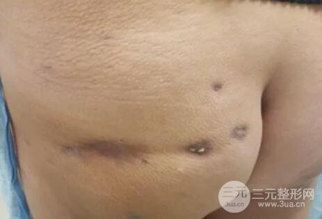 图2. 患者左边臀部术后4个月，多呈紫褐色凹陷、软斑、黄斑。中心病变，挤压白色角化物，以获得皮肤活检。