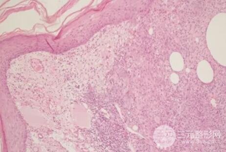 货源优质有发炎的地方，有组织细胞巨细胞，淋巴细胞,。(苏木精-伊红染色;原放大倍数：×40.)