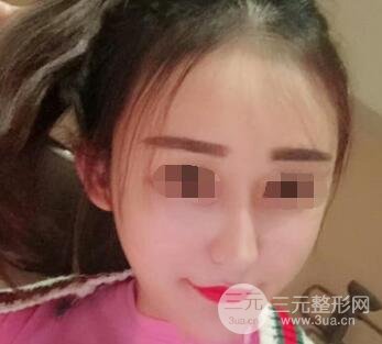 填充的同时,促进胶原蛋白新生