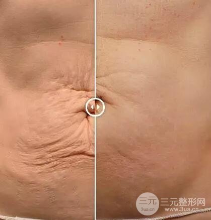 图:热玛吉腹部收紧果