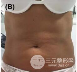 图1:49岁女性求美者,2次注射面部抗衰,每次1瓶,12个月对比图