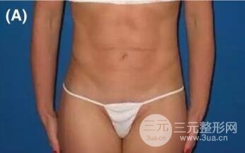 图2:49岁女性求美者,1次注射面部抗衰,每次2瓶,12个月对比图