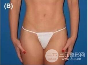 图2:49岁女性求美者,1次注射面部抗衰,每次2瓶,12个月对比图