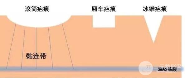 聚左旋乳酸