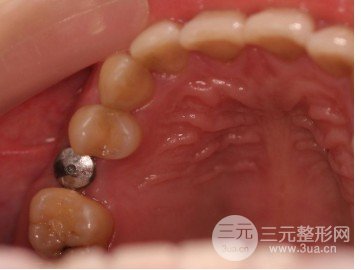 种植牙多少钱一颗