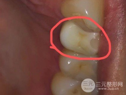种植牙多少钱一颗