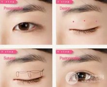 割双眼皮埋线可好？万一埋线失败还能恢复如初么?