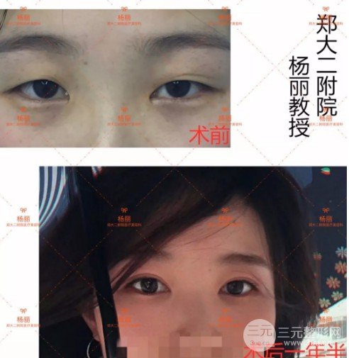 做双眼皮手术恢复时间