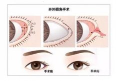 开外眼角前后对比，开眼角较恼人的事—疤痕增生