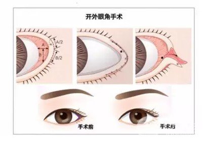 开外眼角前后对比