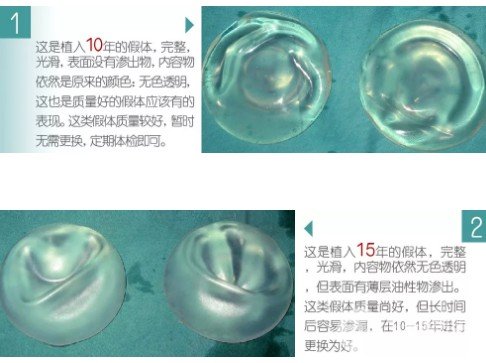 硅胶假体丰胸能保持一辈子吗