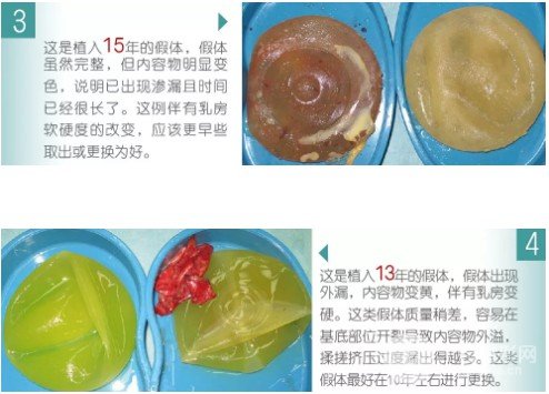 硅胶假体丰胸能保持一辈子吗