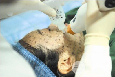 热玛吉操作流程