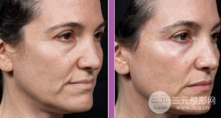 热玛吉原理及作用