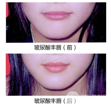 玻尿酸注射丰唇方法
