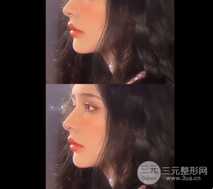 玻尿酸注射丰唇方法