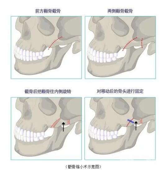 改良脸型直接、有的方法是做磨骨手术!