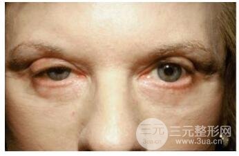 上睑下垂