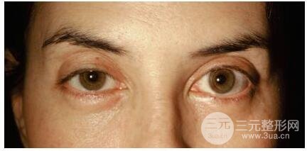 图：患者在眶周注射注射瘦脸，用于除皱和提升眉毛