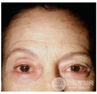 图:这位求美者使用注射瘦脸来缓解右侧过深的额纹之后,发生了右眼上睑下垂。提示我们,求美者本身就有习惯性挑眉的动作来使得睑裂对称。