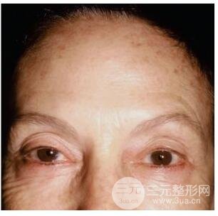 图：这位患者使用注射瘦脸来缓解右侧过深的额纹之后，发生了右眼上睑下垂。提示我们，患者本身就有习惯性挑眉的动作来使得睑裂对称。
