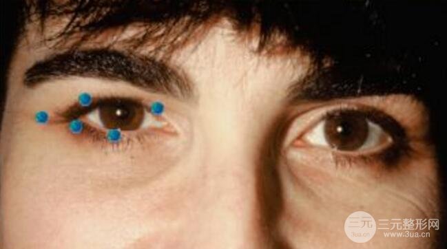 图：眼睑痉挛患者注射注射瘦脸前后对比，注意睑裂的对称度的改良。