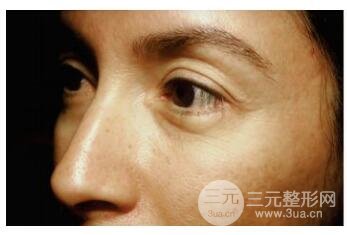 图：注意患者注射前后卧蚕处的变化以及双眼皮的宽度