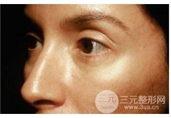 图：注意患者注射前后卧蚕处的变化以及双眼皮的宽度