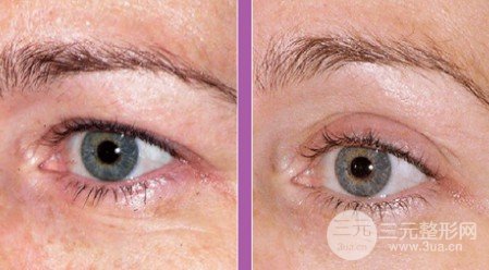 热玛吉美容除皱价格