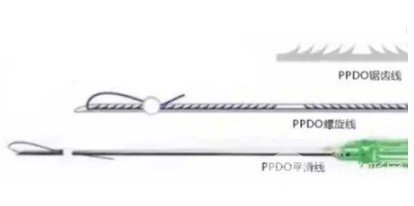 热玛吉和埋线除皱哪个好