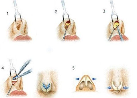 隆鼻手术方法