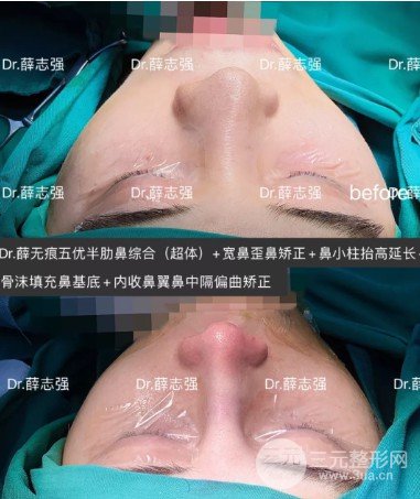 隆鼻手术方法