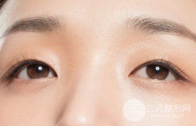 埋线双眼皮手术过程