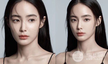 垫下巴多长时间恢复