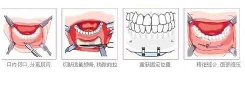 垫下巴多长时间恢复