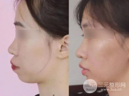 垫下巴多长时间恢复