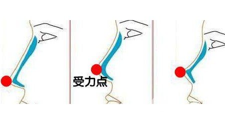 硅胶隆鼻整形手术