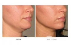 做完热玛吉注意事项，哪些医院有来自正规渠道热玛吉?