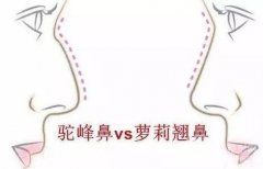 驼峰鼻子是怎么来的？医院怎么矫正?