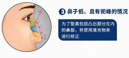 驼峰鼻子是怎么来的