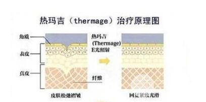 为什么有些人在完成热玛吉后没有果?