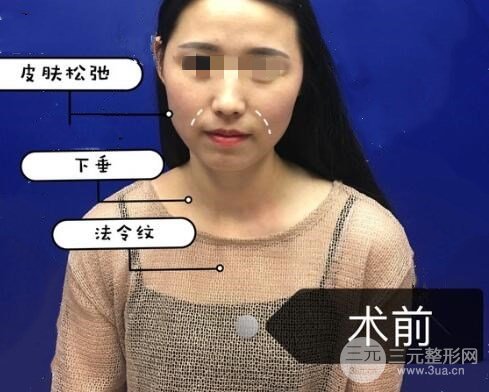 热玛吉真实体验过程