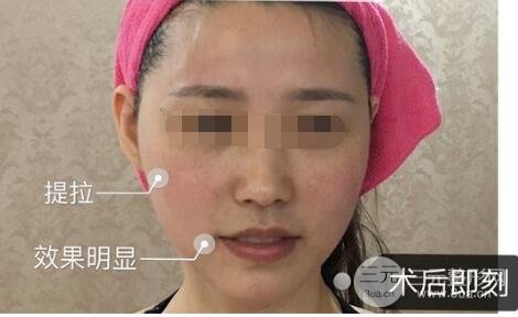 热玛吉真实体验过程