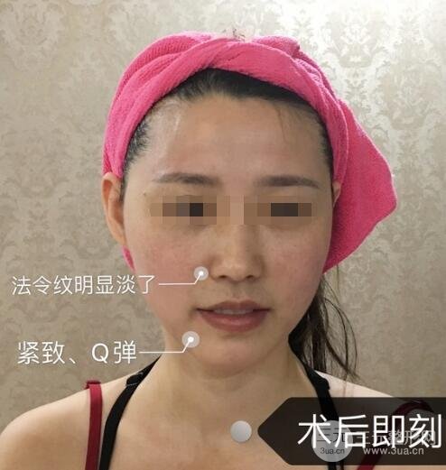 热玛吉真实体验过程