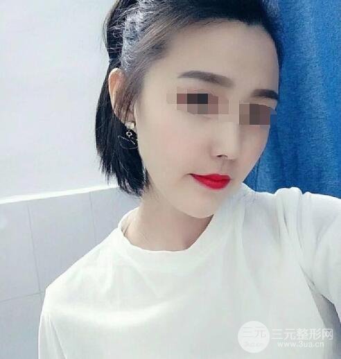 热玛吉真实体验过程