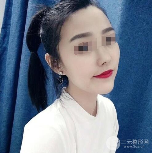 热玛吉真实体验过程