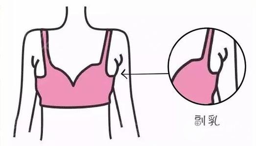 【科普】副乳切除手术几天恢复?手术注意事项~
